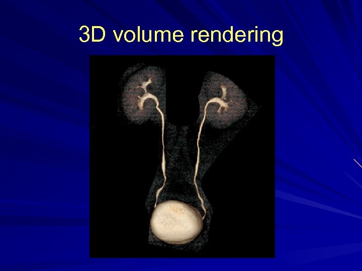 3 D volume rendering 