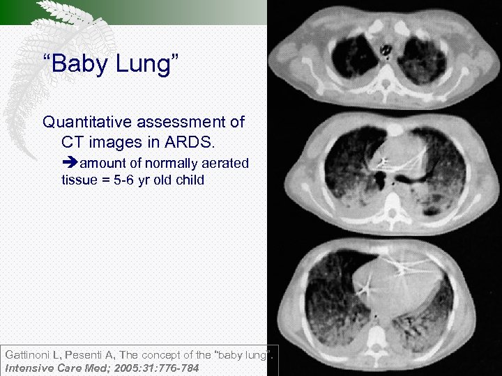 “Baby Lung” Quantitative assessment of CT images in ARDS. amount of normally aerated tissue