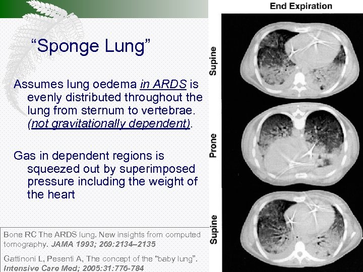 “Sponge Lung” Assumes lung oedema in ARDS is evenly distributed throughout the lung from