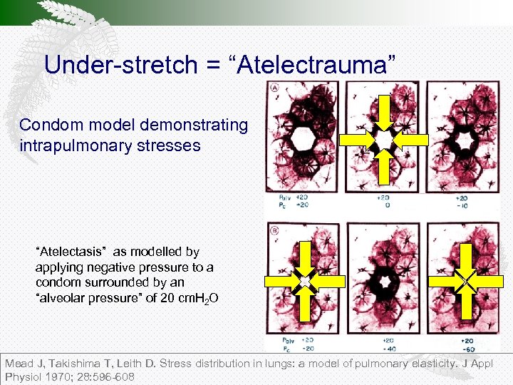 Under-stretch = “Atelectrauma” Condom model demonstrating intrapulmonary stresses “Atelectasis” as modelled by applying negative