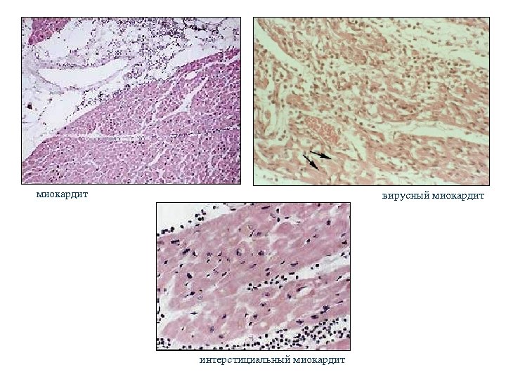 миокардит вирусный миокардит интерстициальный миокардит 