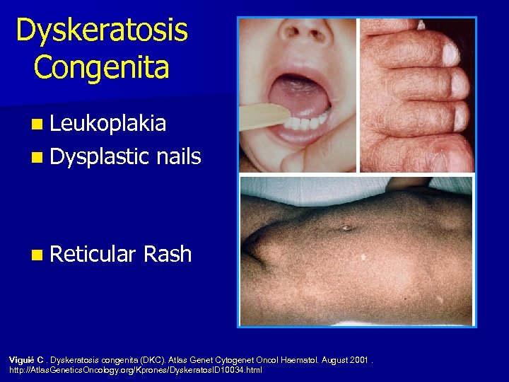 Dyskeratosis Congenita n Leukoplakia n Dysplastic n Reticular nails Rash Viguié C. Dyskeratosis congenita