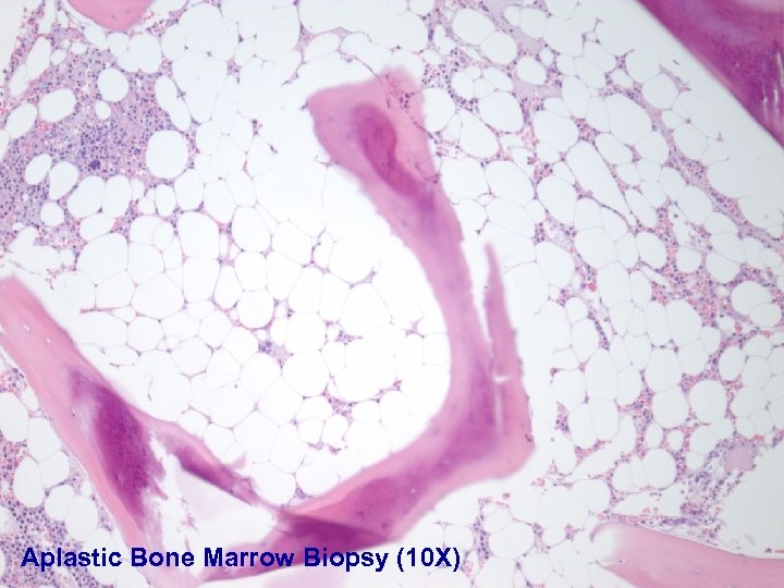 Aplastic Bone Marrow Biopsy (10 X) 