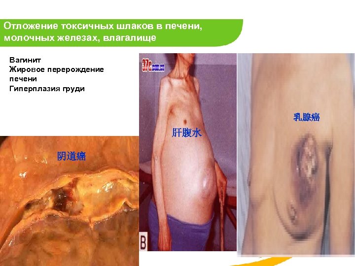 Отложение токсичных шлаков в печени, молочных железах, влагалище Вагинит Жировое перерождение печени Гиперплазия груди