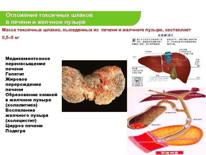 Отложение токсичных шлаков в печени и желчном пузыре Масса токсичных шлаков, выведенных из печени