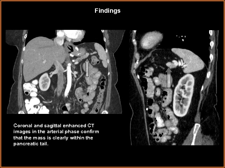 Findings Coronal and sagittal enhanced CT images in the arterial phase confirm that the