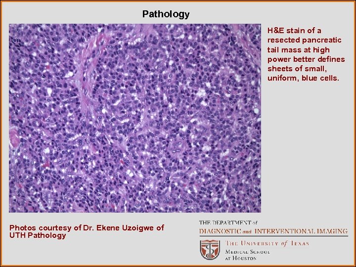 Pathology H&E stain of a resected pancreatic tail mass at high power better defines