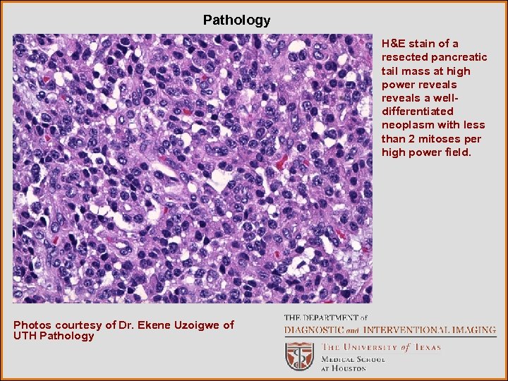 Pathology H&E stain of a resected pancreatic tail mass at high power reveals a