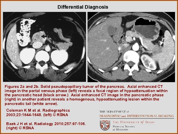 Differential Diagnosis Figures 2 a and 2 b. Solid pseudopapillary tumor of the pancreas.