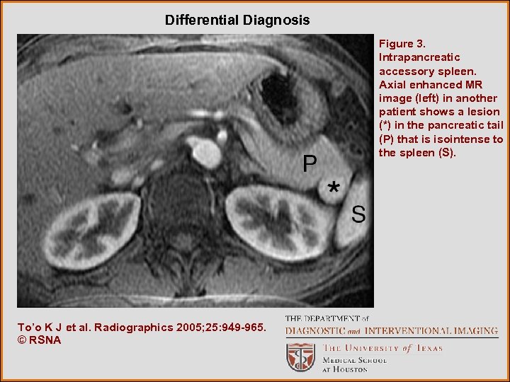 Differential Diagnosis Figure 3. Intrapancreatic accessory spleen. Axial enhanced MR image (left) in another