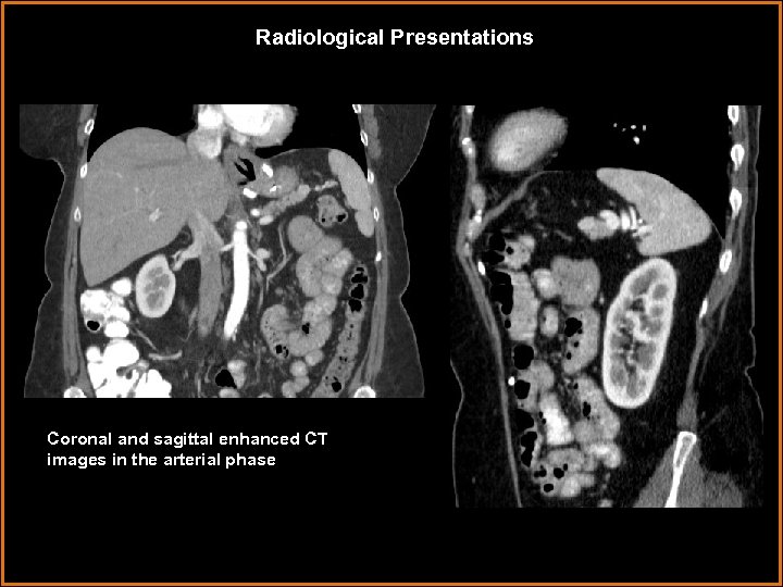 Radiological Presentations Coronal and sagittal enhanced CT images in the arterial phase 