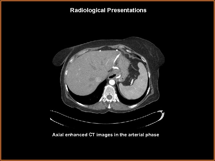 Radiological Presentations Axial enhanced CT images in the arterial phase 