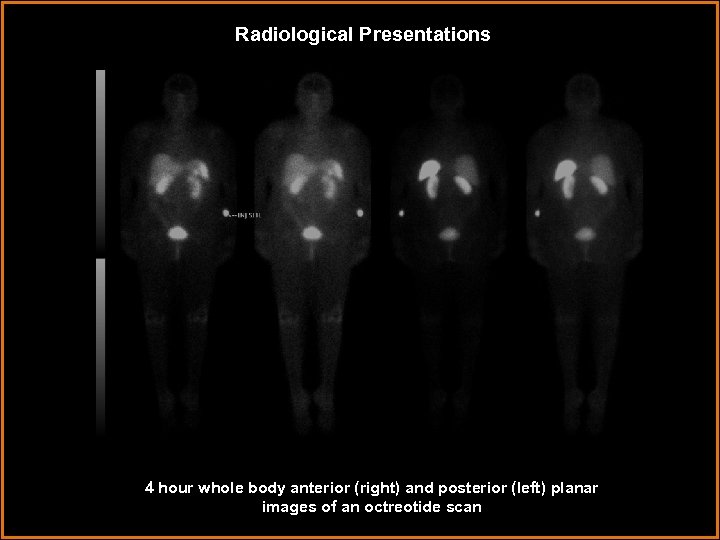 Radiological Presentations 4 hour whole body anterior (right) and posterior (left) planar images of