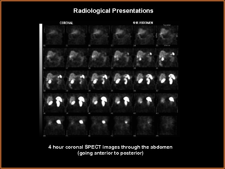 Radiological Presentations 4 hour coronal SPECT images through the abdomen (going anterior to posterior)