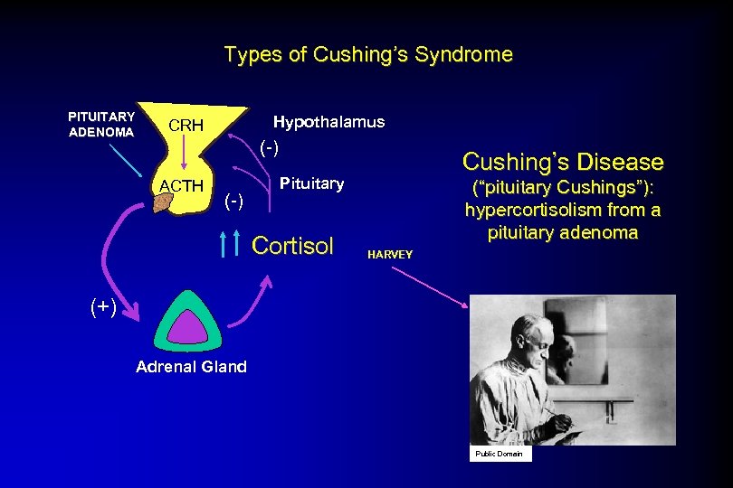 Types of Cushing’s Syndrome PITUITARY ADENOMA Hypothalamus CRH (-) ACTH (-) Cushing’s Disease Pituitary