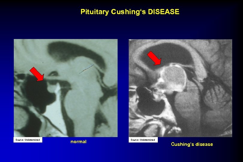 Pituitary Cushing‘s DISEASE Source: Undetermined normal Source: Undetermined Cushing’s disease 