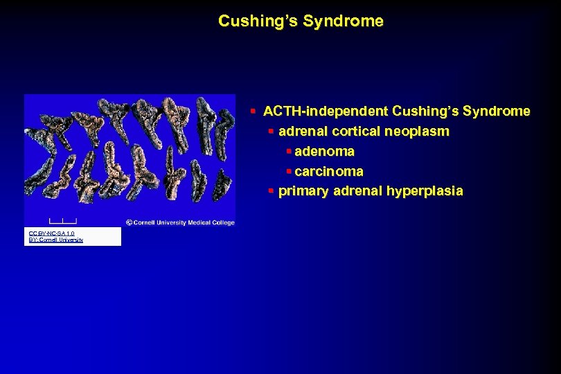 Cushing’s Syndrome § ACTH-independent Cushing’s Syndrome § adrenal cortical neoplasm § adenoma § carcinoma