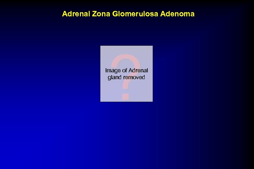 Adrenal Zona Glomerulosa Adenoma ? Image of Adrenal gland removed 
