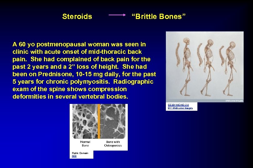Steroids “Brittle Bones” A 60 yo postmenopausal woman was seen in clinic with acute