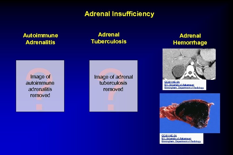 Adrenal Insufficiency Autoimmune Adrenalitis Adrenal Tuberculosis ? ? Image of autoimmune adrenalitis removed Image