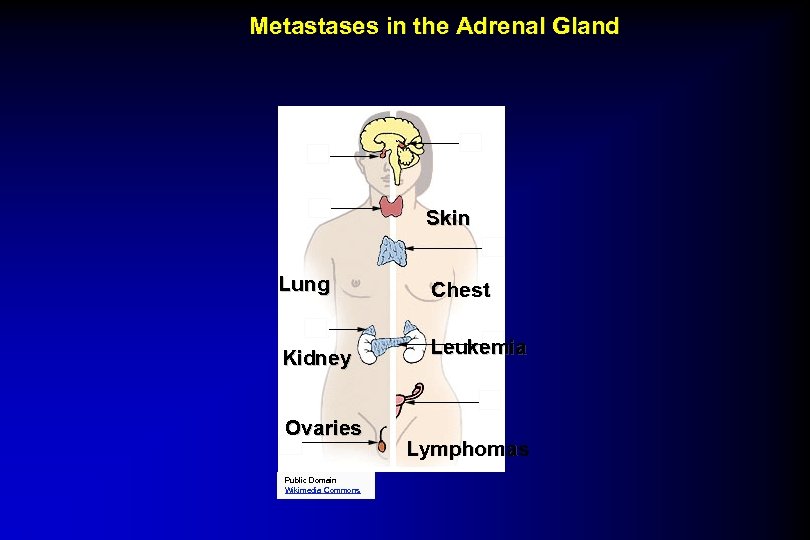 Metastases in the Adrenal Gland Skin Lung Chest Kidney Leukemia Ovaries Public Domain Wikimedia