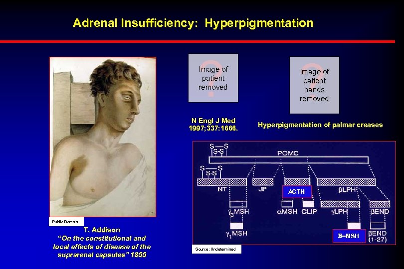 Adrenal Insufficiency: Hyperpigmentation ? Image of patient removed N Engl J Med 1997; 337: