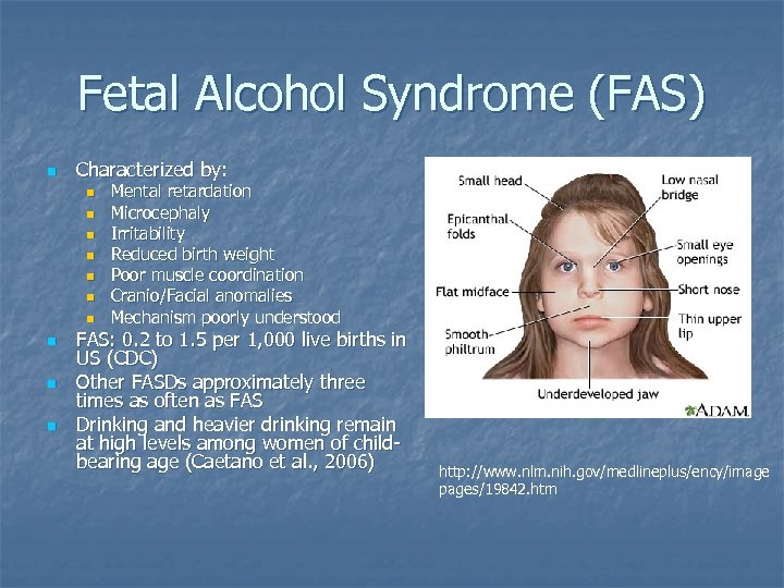 Fetal Alcohol Syndrome (FAS) n Characterized by: n n n n n Mental retardation