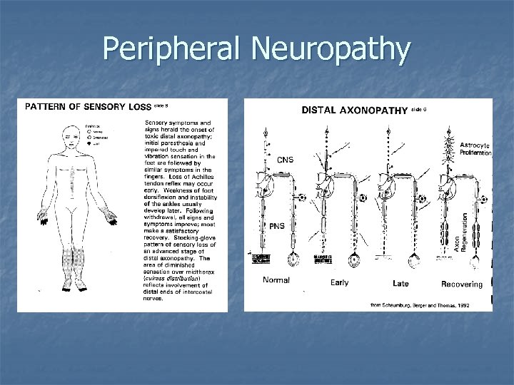 Peripheral Neuropathy 