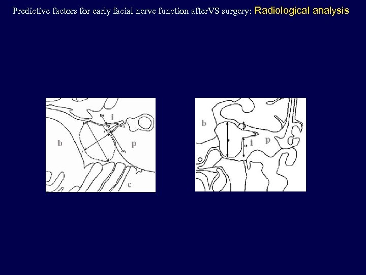 Predictive factors for early facial nerve function after. VS surgery: Radiological analysis 