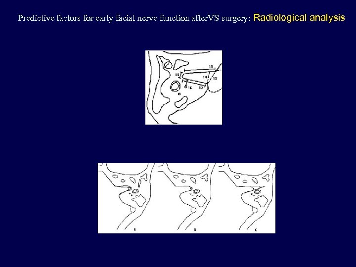 Predictive factors for early facial nerve function after. VS surgery: Radiological analysis 