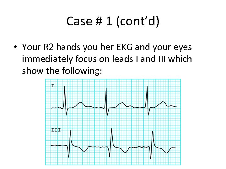 Case # 1 (cont’d) • Your R 2 hands you her EKG and your