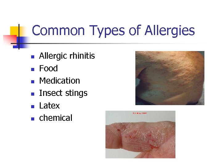 Common Types of Allergies n n n Allergic rhinitis Food Medication Insect stings Latex