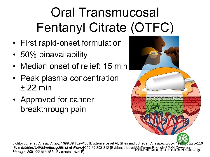 Oral Transmucosal Fentanyl Citrate (OTFC) • • First rapid onset formulation 50% bioavailability Median
