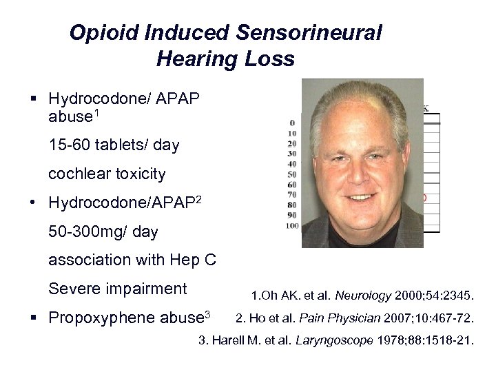 Opioid Induced Sensorineural Hearing Loss § Hydrocodone/ APAP abuse 1 15 60 tablets/ day