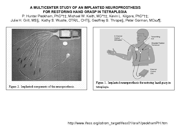 A MULTICENTER STUDY OF AN IMPLANTED NEUROPROSTHESIS FOR RESTORING HAND GRASP IN TETRAPLEGIA P.