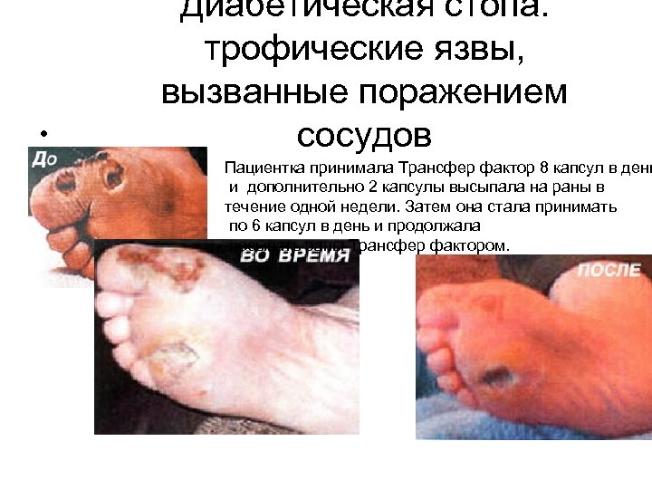  • Диабетическая стопа. трофические язвы, вызванные поражением сосудов Пациентка принимала Трансфер фактор 8