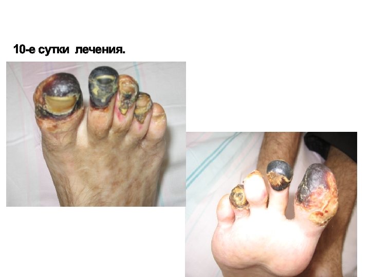 10 -е сутки лечения. 