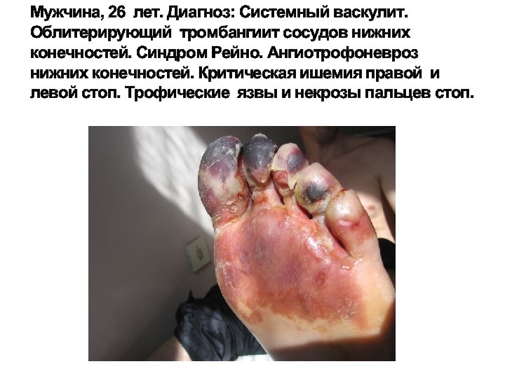 Мужчина, 26 лет. Диагноз: Системный васкулит. Облитерирующий тромбангиит сосудов нижних конечностей. Синдром Рейно. Ангиотрофоневроз