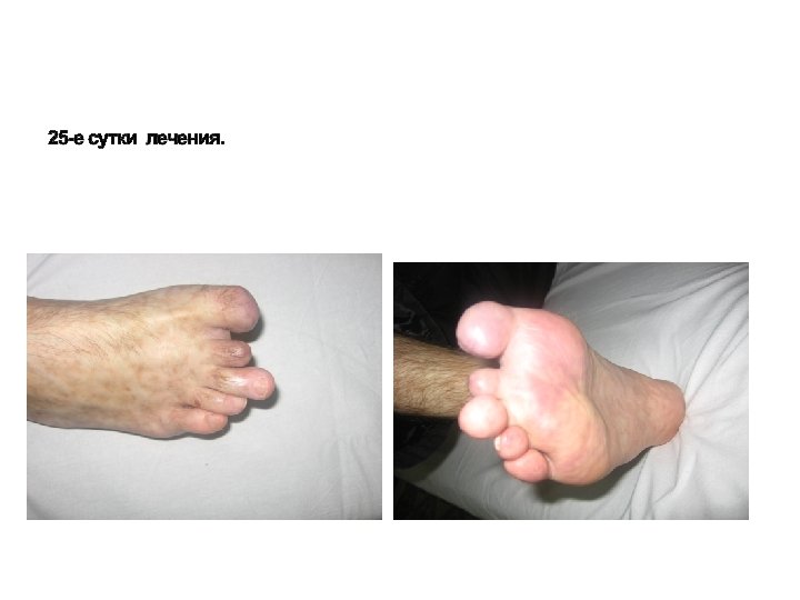 25 -е сутки лечения. 
