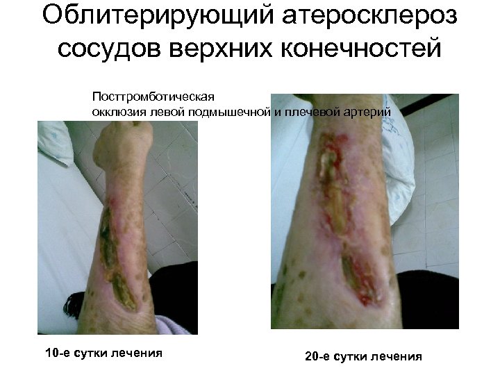 Облитерирующий атеросклероз сосудов верхних конечностей Посттромботическая окклюзия левой подмышечной и плечевой артерий 10 -е
