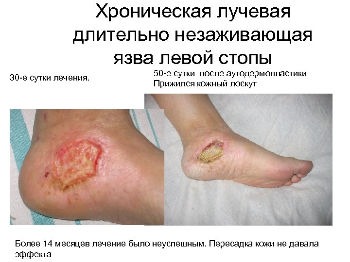 Хроническая лучевая длительно незаживающая язва левой стопы 30 -е сутки лечения. 50 -е сутки