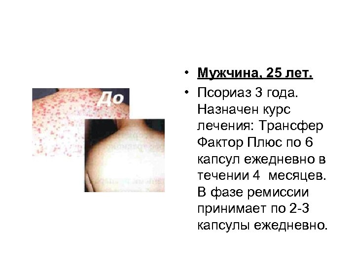  • Мужчина, 25 лет. • Псориаз 3 года. Назначен курс лечения: Трансфер Фактор
