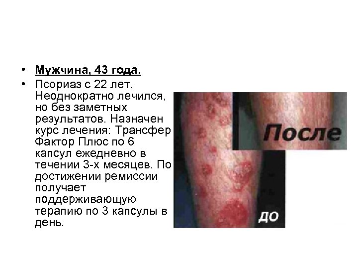  • Мужчина, 43 года. • Псориаз с 22 лет. Неоднократно лечился, но без