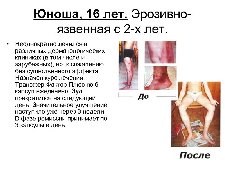 Юноша, 16 лет. Эрозивноязвенная с 2 -х лет. • Неоднократно лечился в различных дерматологических