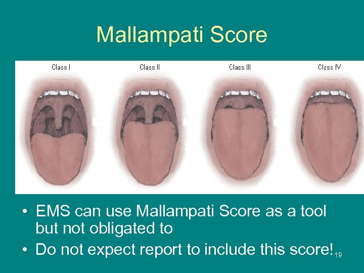 Mallampati Score • EMS can use Mallampati Score as a tool but not obligated