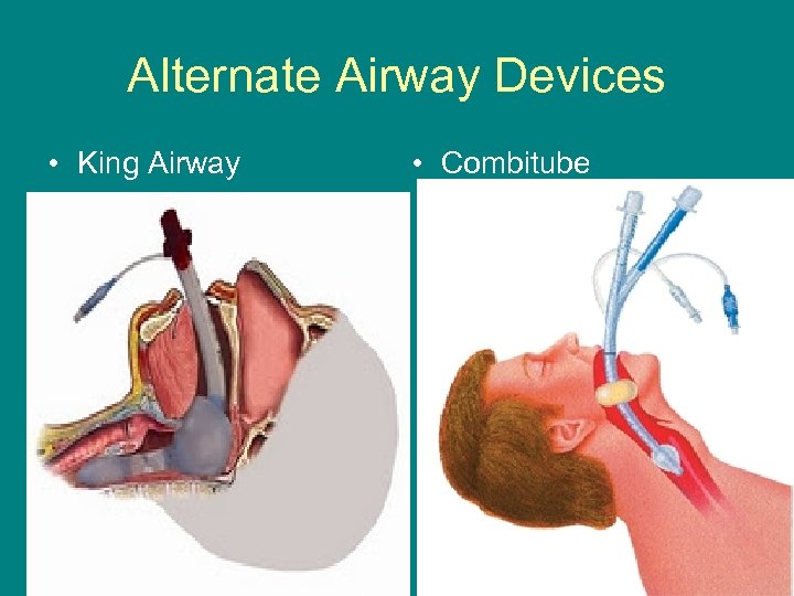 Alternate Airway Devices • King Airway • Combitube 