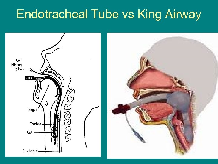 Endotracheal Tube vs King Airway 58 