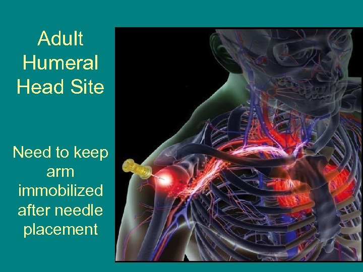 Adult Humeral Head Site Need to keep arm immobilized after needle placement 65 