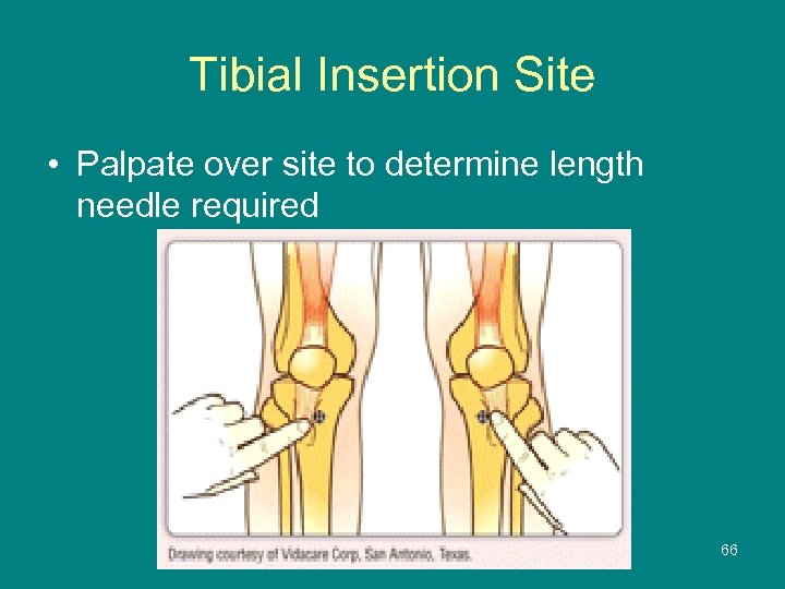 Tibial Insertion Site • Palpate over site to determine length needle required 66 