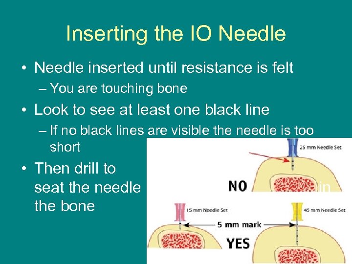 Inserting the IO Needle • Needle inserted until resistance is felt – You are